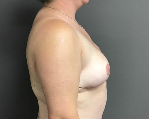Side After