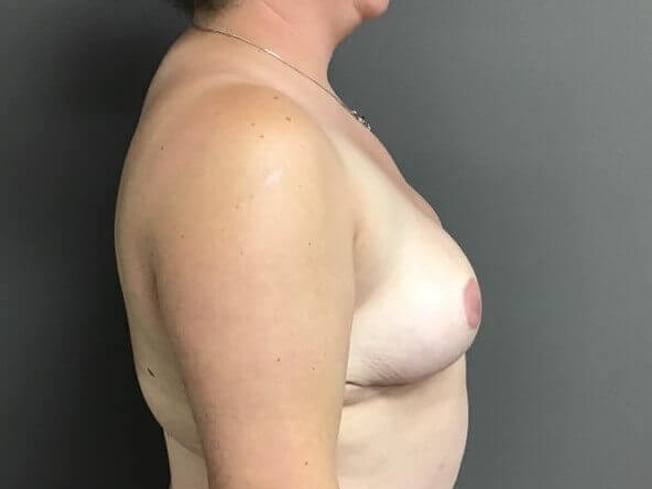 Side After