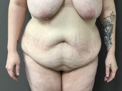 Anterior Before