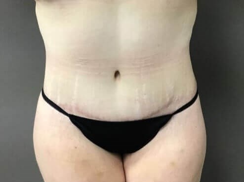 Anterior After