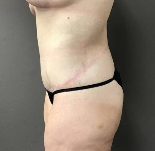 Side After
