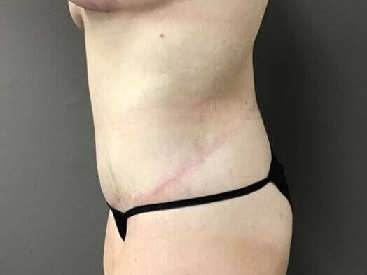 Side After