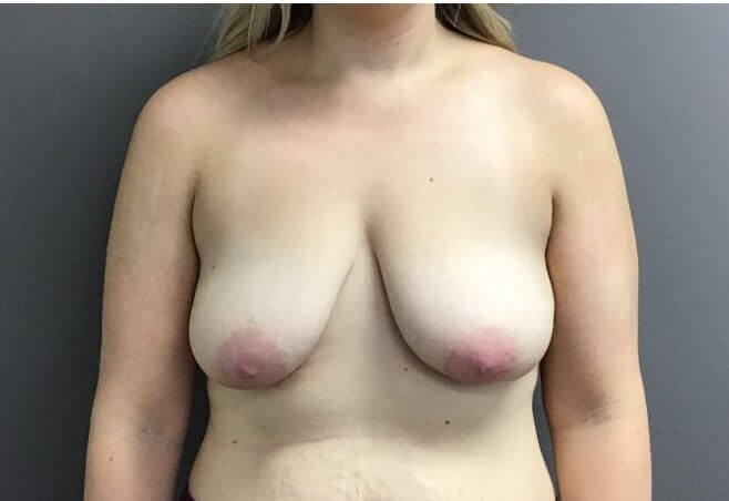 Anterior Before