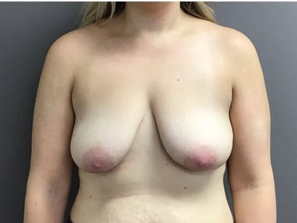 Anterior Before