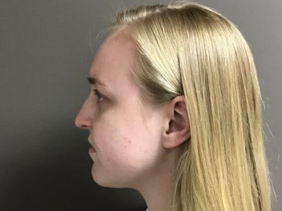 Side Before