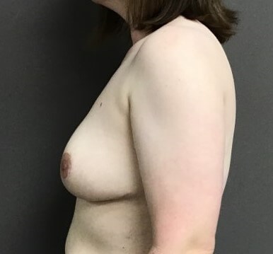 Side After