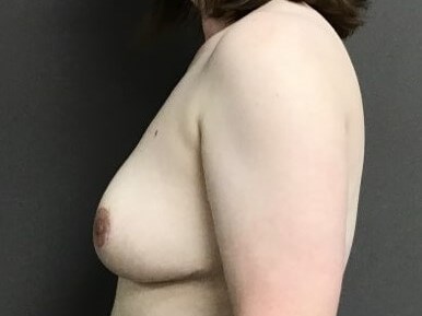 Side After