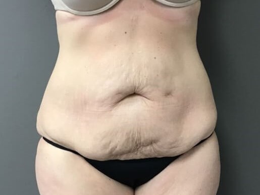 Anterior Before