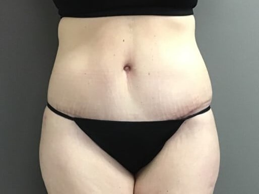 Anterior After