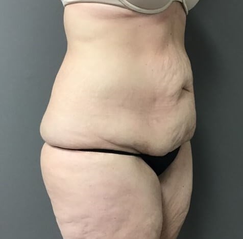 Oblique Before