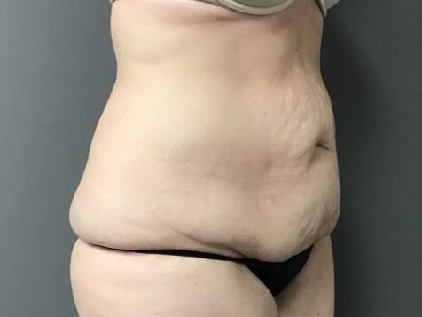 Oblique Before