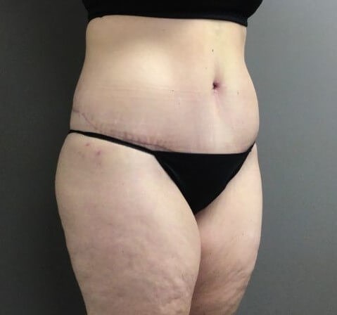 Oblique After