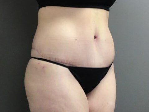 Oblique After