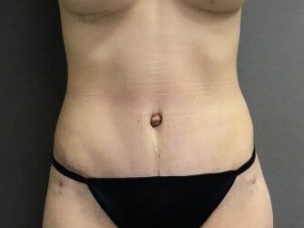 Anterior After
