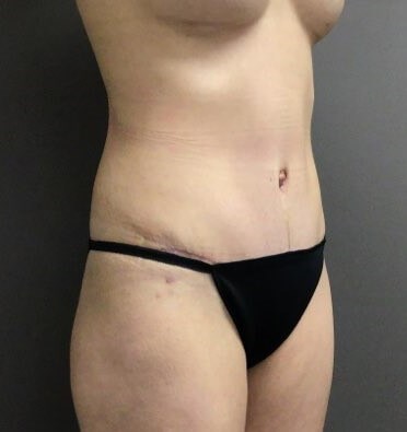 Oblique After