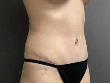 Oblique After