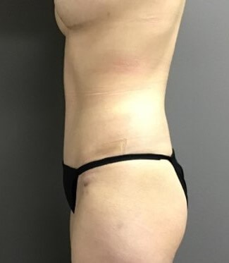Side After