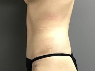 Side After