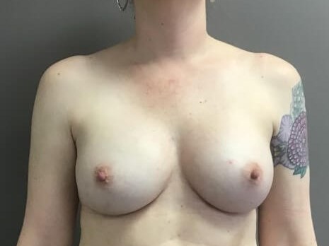 Anterior After