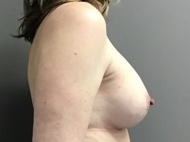 Side Before