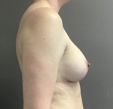Side After