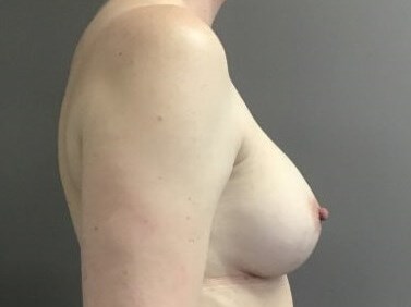 Side After