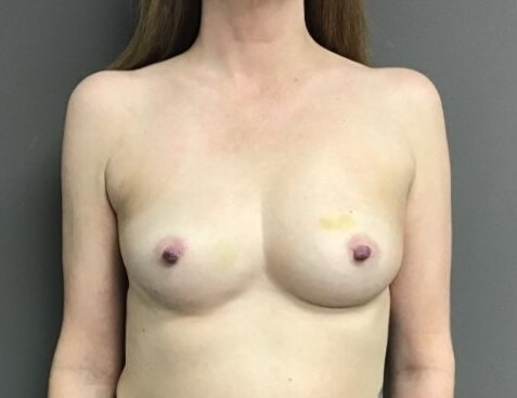 Anterior Before