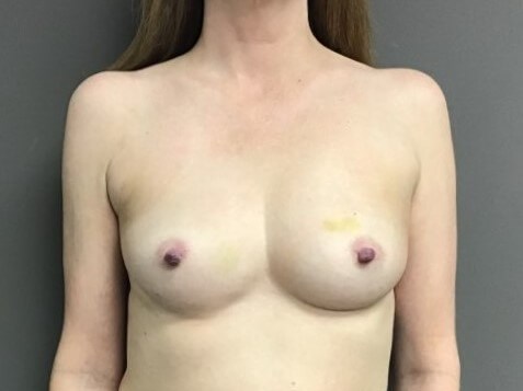 Anterior Before