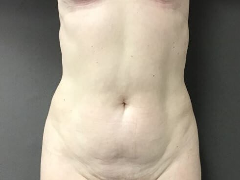 Anterior Before