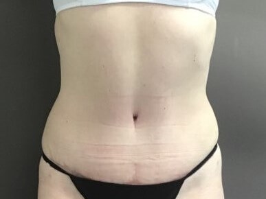 Anterior After
