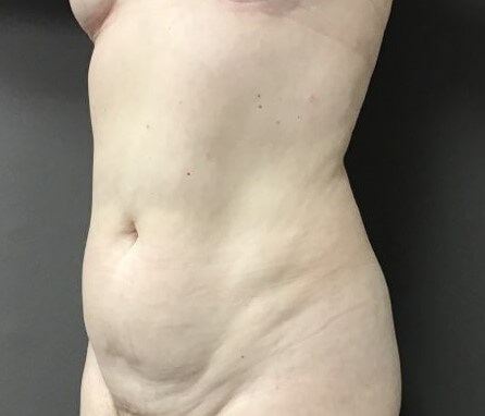 Oblique Before