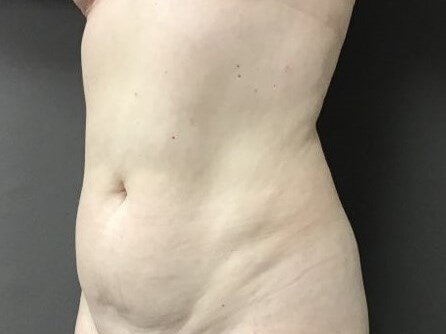 Oblique Before