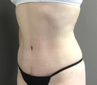 Oblique After
