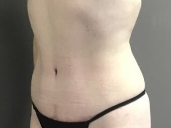 Oblique After