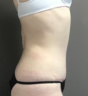Side After