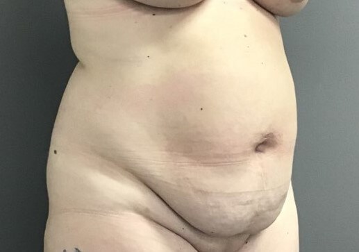 Oblique Before