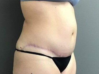 Oblique After