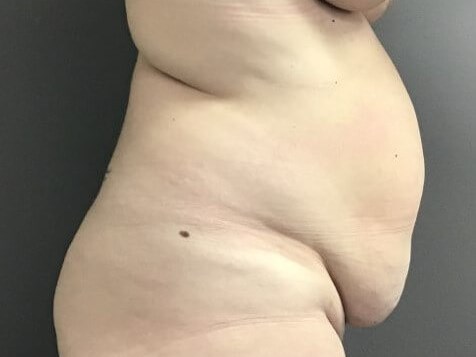 Side Before