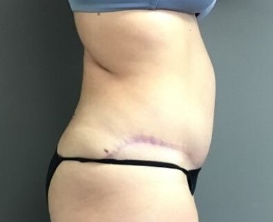 Side After