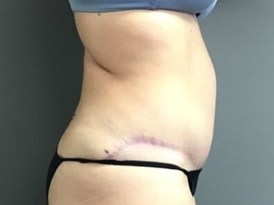 Side After