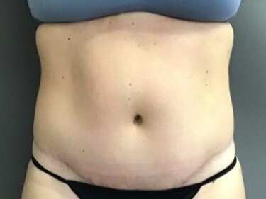 Anterior After