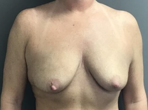 Anterior Before