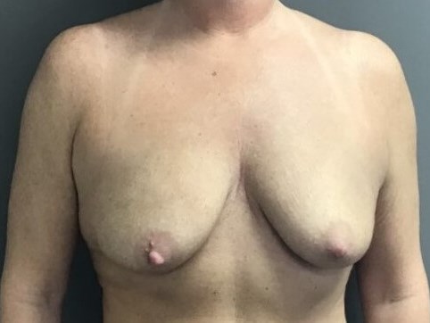 Anterior Before