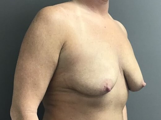 Oblique Before