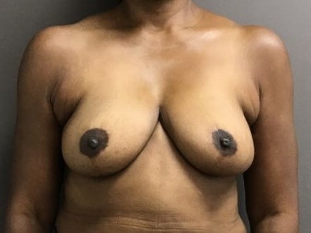 Anterior After