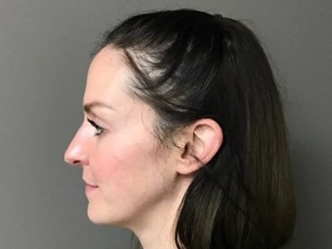 Side Before