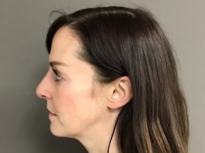 Side After
