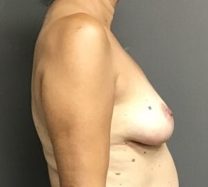Side Before