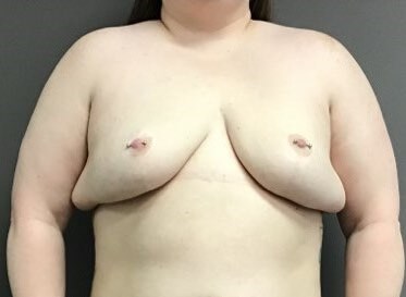 Anterior Before