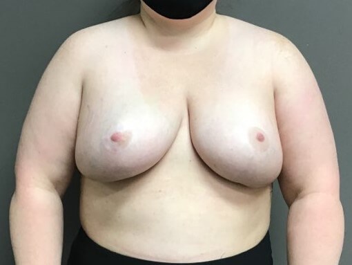 Anterior After